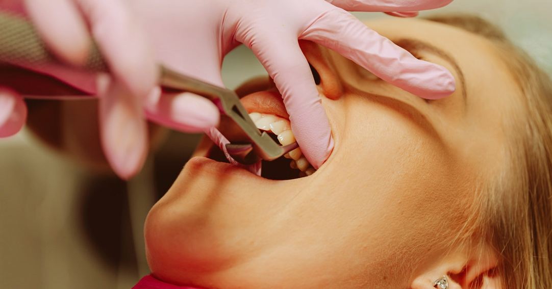 dental implant