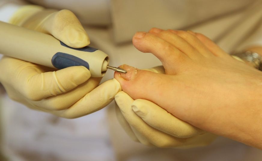 ingrown toenail relief houston